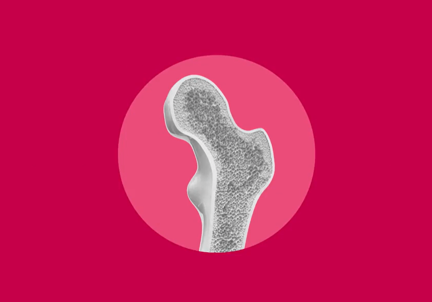 Hybride Therapiemodelle bei Osteoporose